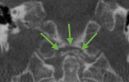 Crown dense syndrome