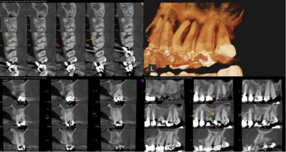 Endodontics Offices CBCT Images – Pearl CBCT – Dr. Morvarid Poorsattar